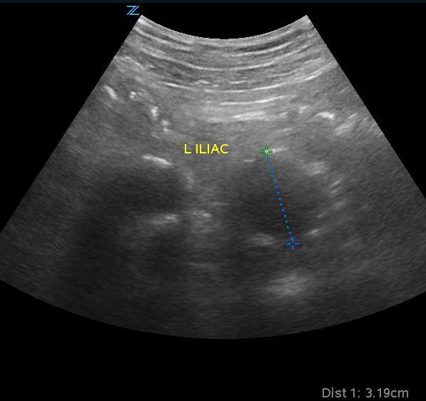 Figure 8- Iliac artery aneurysm.jpg