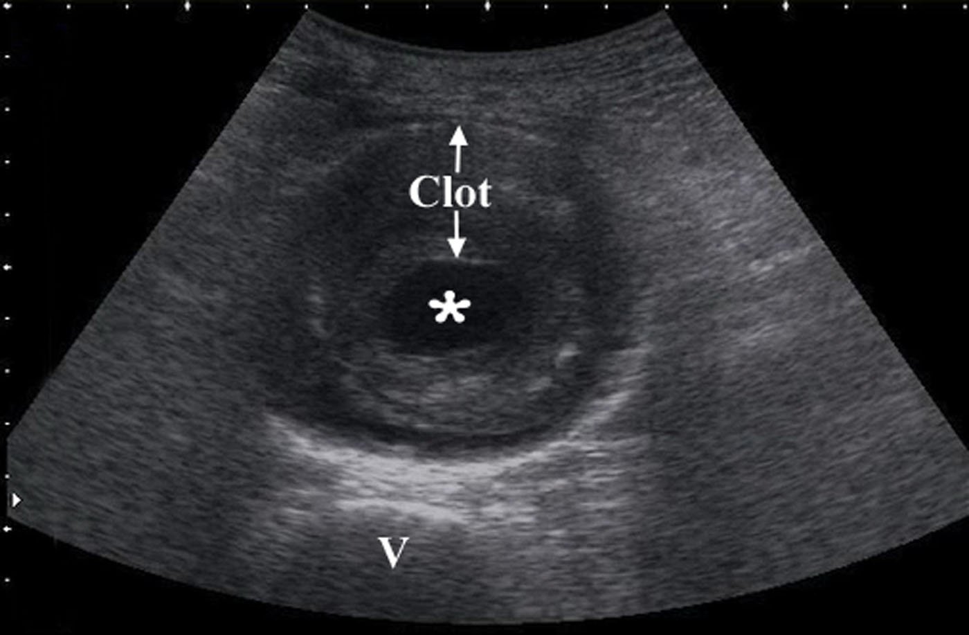 Figure 9- Transverse view of a 7 cm AAA with intraluminal clot on the lumen v denotes vertebral body.jpg