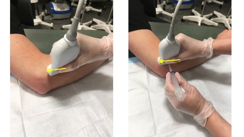 Figure 10 - Transducer placement for elbow arthrocentesis .jpg