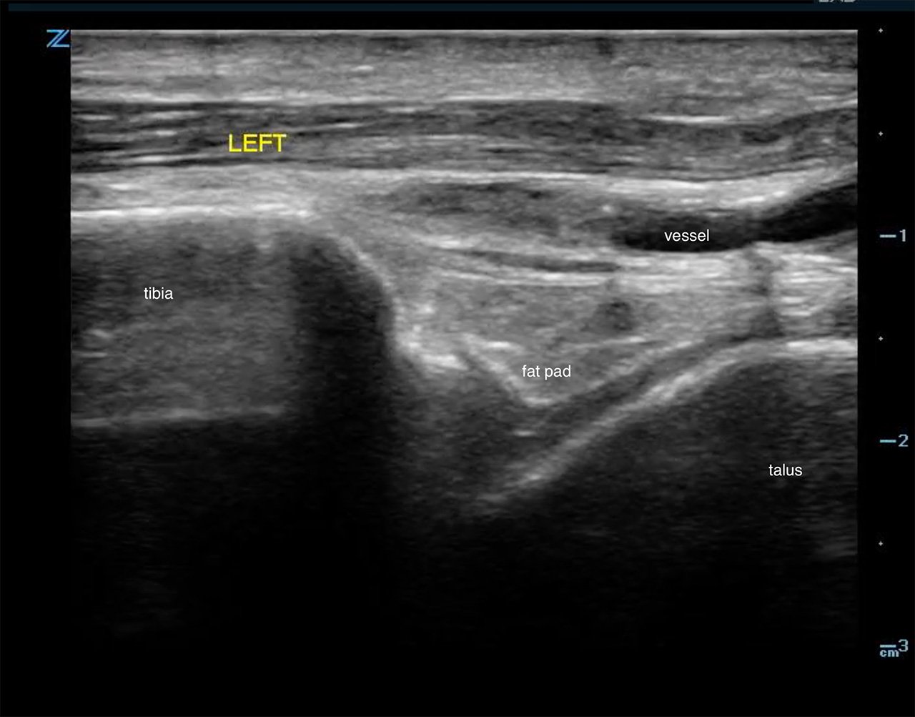Figure 2a - US demonstrating normal ankle.jpg