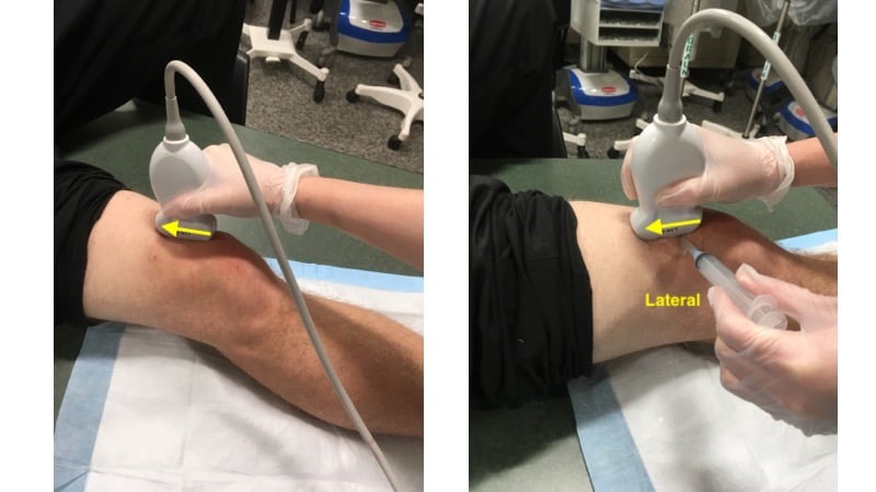 Figure 3 -  Transducer Placement for knee arthrocentesis.jpg
