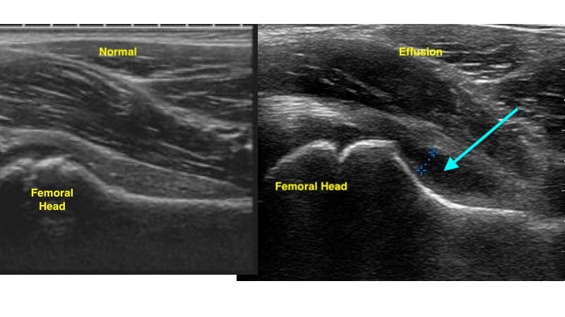 Figure 7 - US demonstrating normal hip (left) and hip effusion (right).jpg
