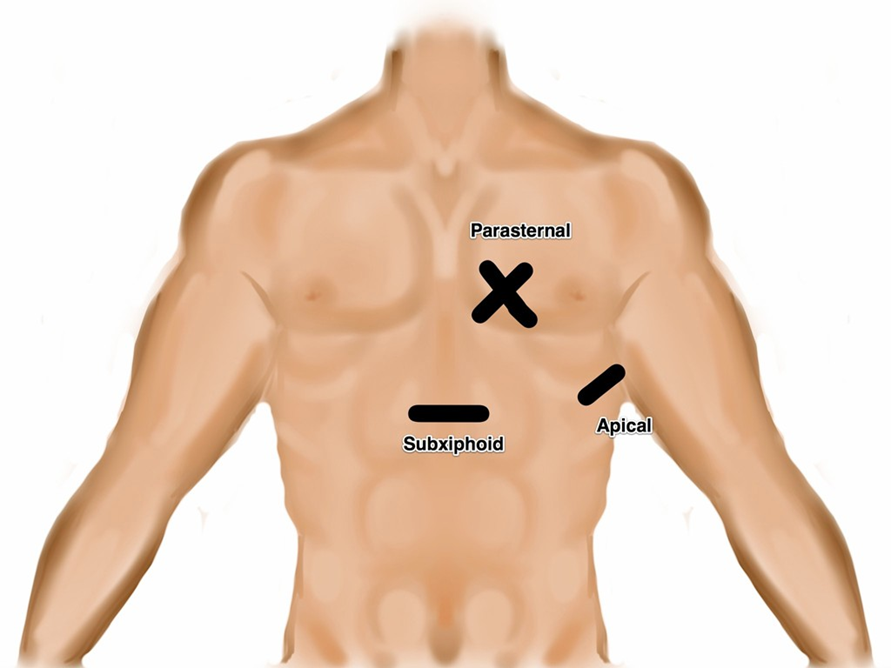 Illustrations 1. Transducer location for the four focused cardiac views.png