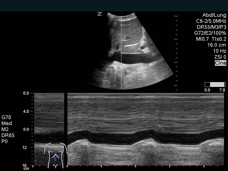 Image 12. Inferior Vena Cava Respiratory variation on M-mode.jpg