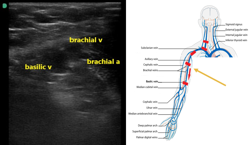 Figure 7 brachial and basilic veins.png