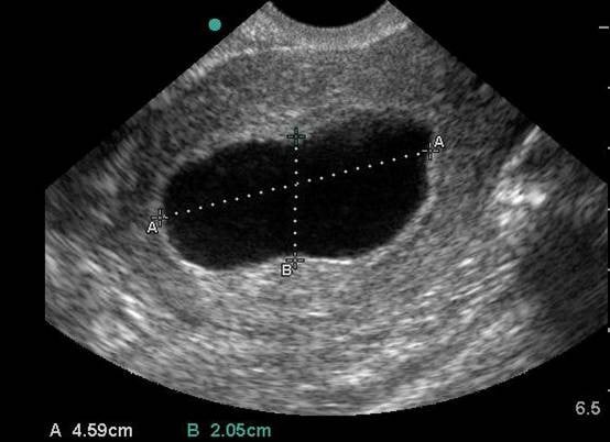 Gestational Sac in Pregnancy and Meaning If Empty