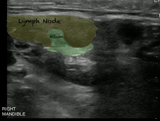 -Figure 12 - Lymph Node with color.png