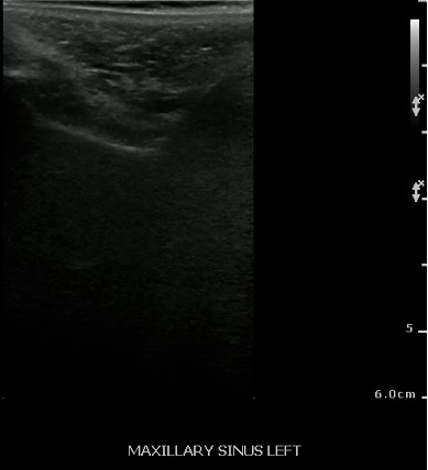 -Figure 27 - Normal Maxillary Sinus.jpg