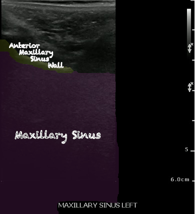 -Figure 28 - Normal Maxillary Sinus.png