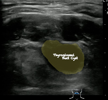 -Figure 35 - Thyroglossal Duct Cyst with Color.png