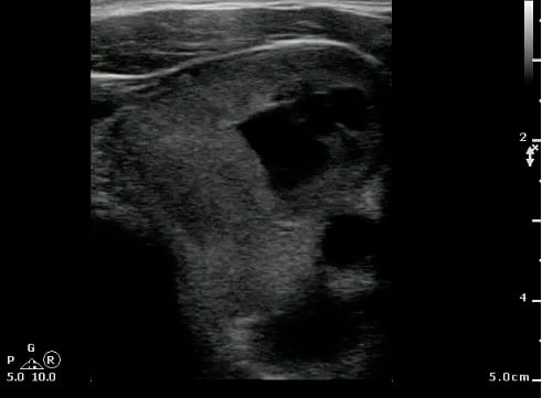 -Figure 38 - Multinodular Thyroid with Internal Cystic Degeneration.jpg