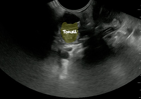 -Figure 43 - Normal Tonsil with Color.png