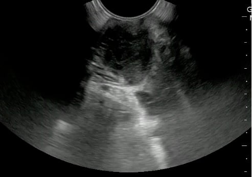 -Figure 51 - Tonsilitis.jpg