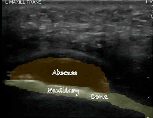 -Figure 9-Maxillary periapical abscess.png