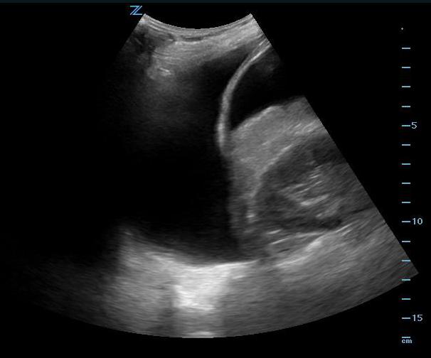 Figure 12 - Positive FAST scan with free fluid in the abdomen as well as pleural effusion.jpg