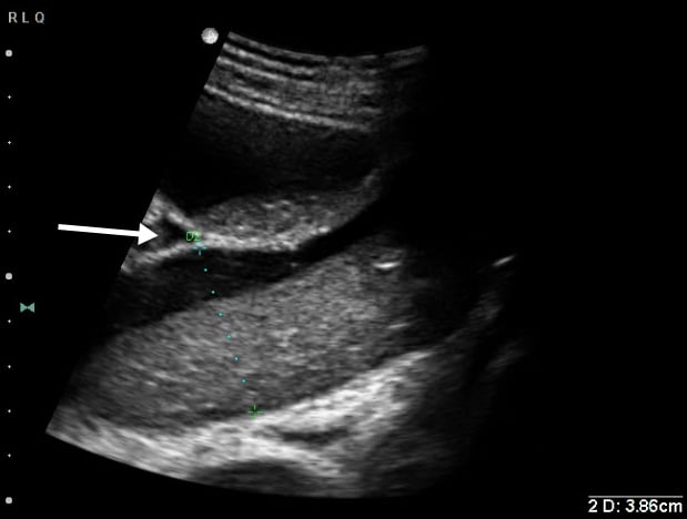 Figure 1 significantly dilated loop of small bowel with bowel lumen  2.5 cm. Also note free fluid interposed between loops of bowel (white arrow).jpg