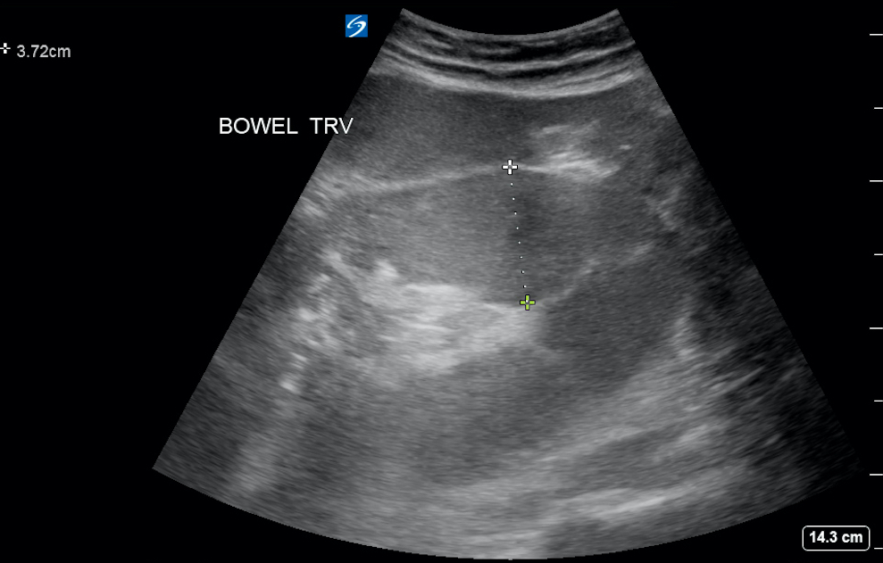 Figure 2 Dilated small bowel in setting of SBO.jpg