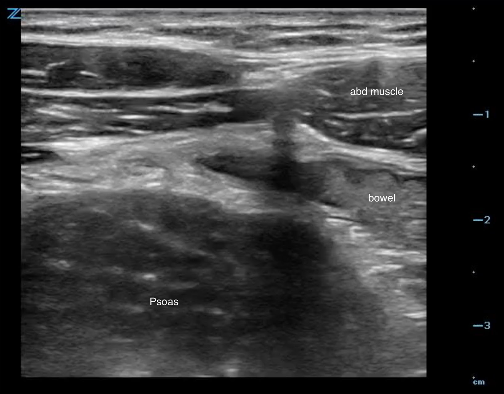 Figure 3 - Psoas muscle in RLQ.jpg