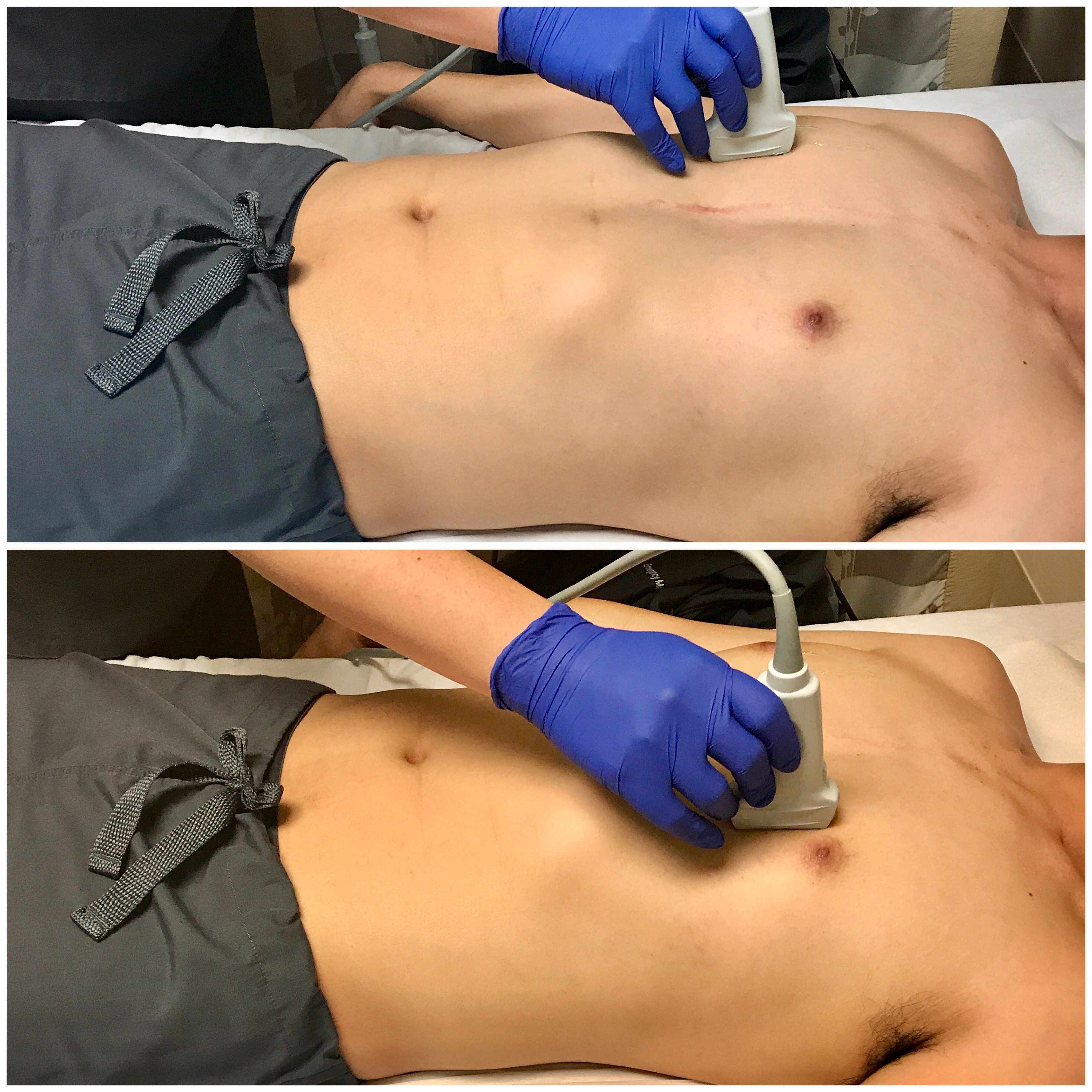 Image 11 - Transducer placement and orientation for evaluating for pneumothorax in the supine patient.jpg