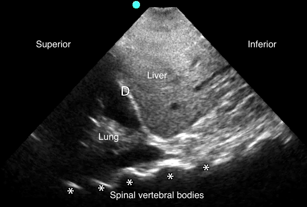 Image 18 - Pleural effusion with spine sign.png