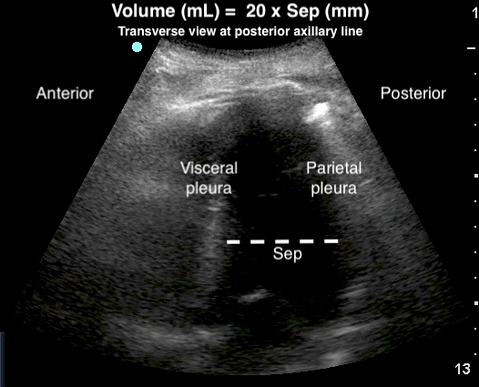 Image 21 - Estimating pleural effusion volume.png