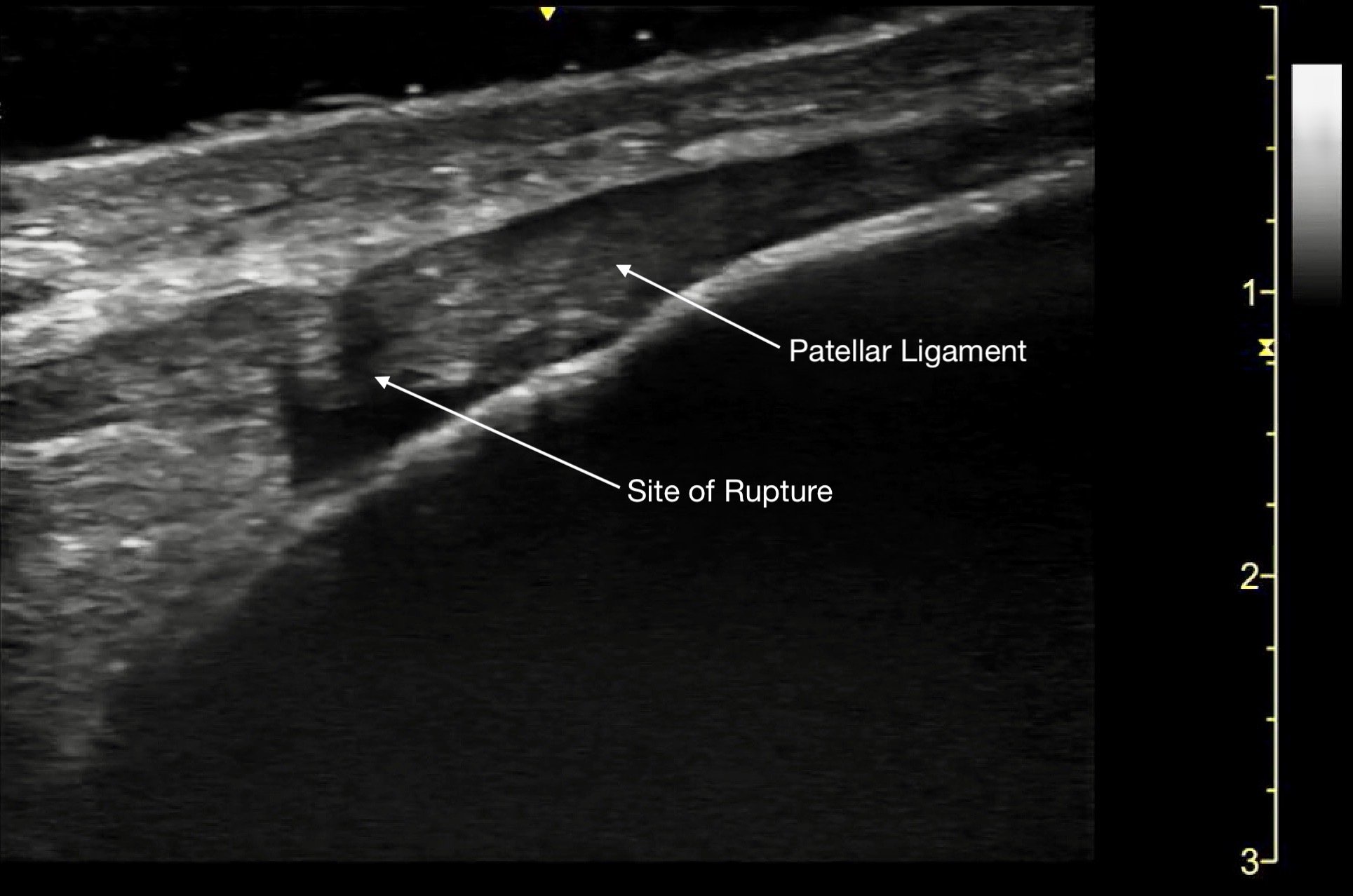 MSK-Figure 13a - Partial rupture.jpeg