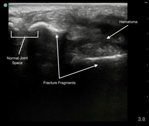 MSK-Figure 6 - Colles fracture.jpeg