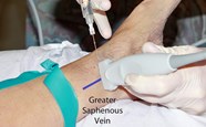 Saphenous Nerve Block Sonoguide
