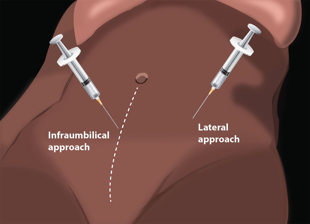 Illustration 1. Schematic view of paracentesis needle placement.jpg