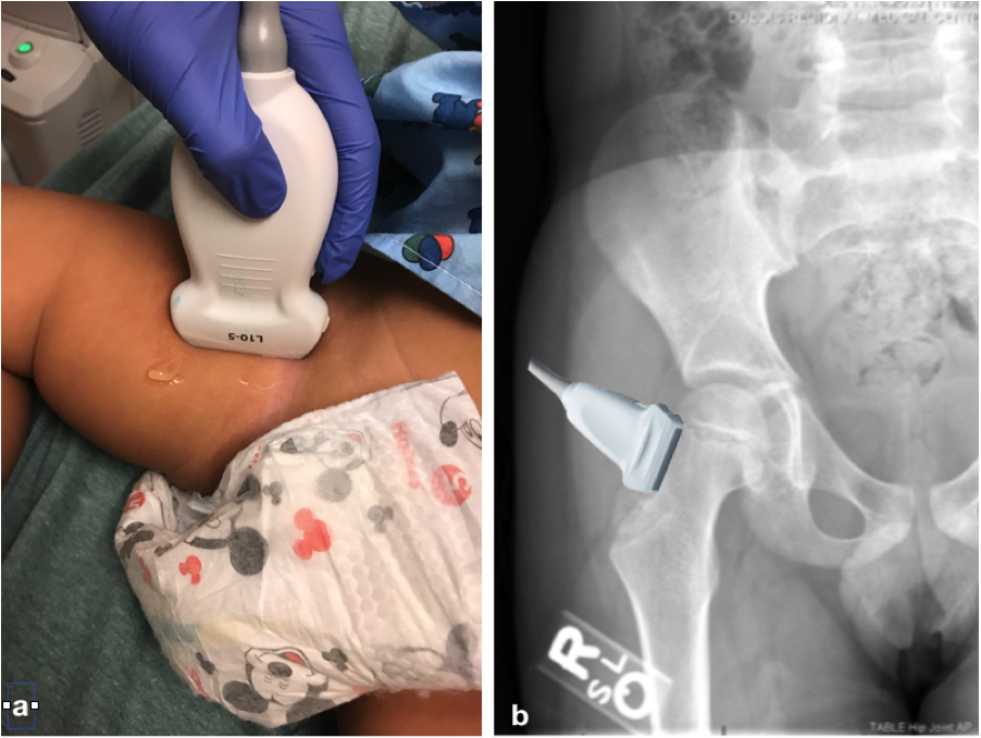 Figure 1. Placement of ultrasound transducer (a) and X-ray of the hip (b).png