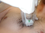 Figure 1- Position of ultrasound probe for pericardiocentesis in parasternal long axis orie_RXTP.jpg
