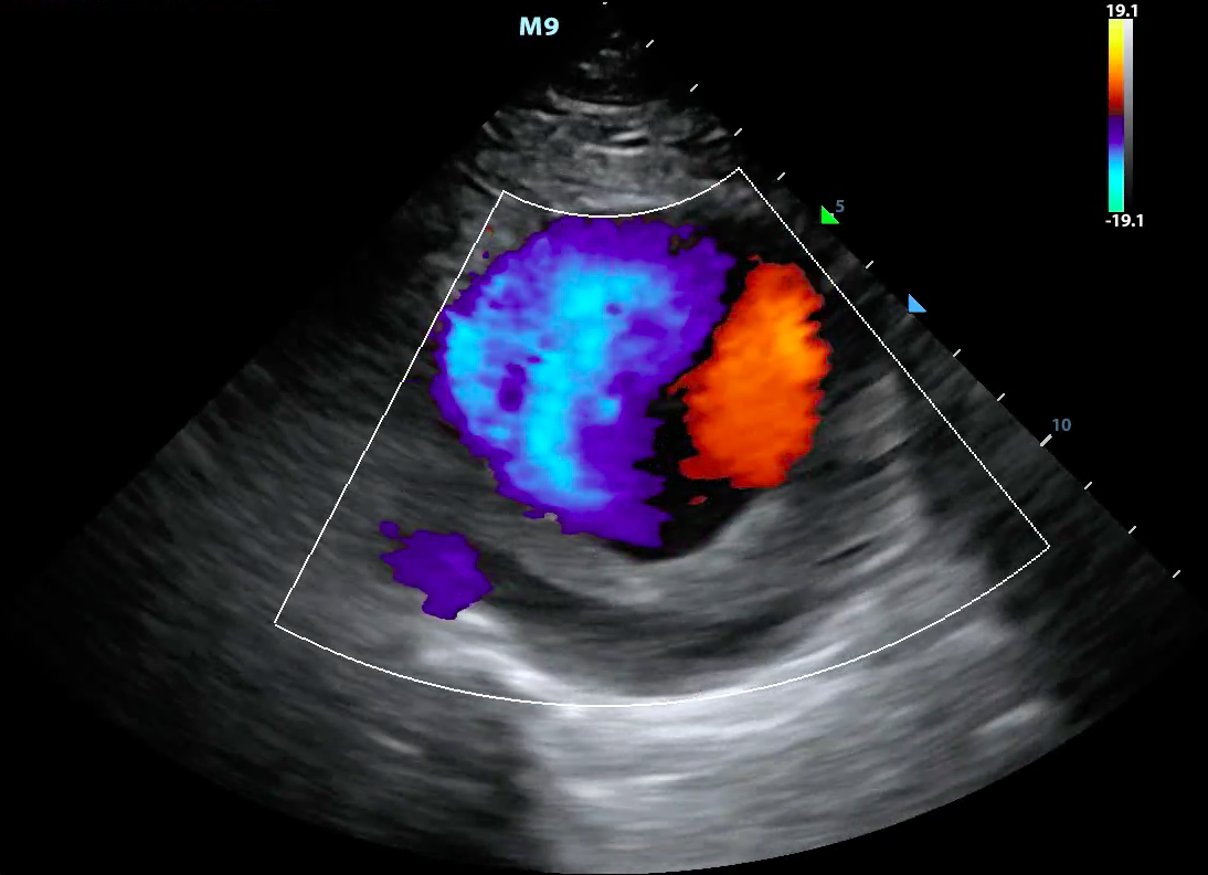 Figure3-Color doppler showing turbulent blood flow in a large abdominal aortic aneurysm.png