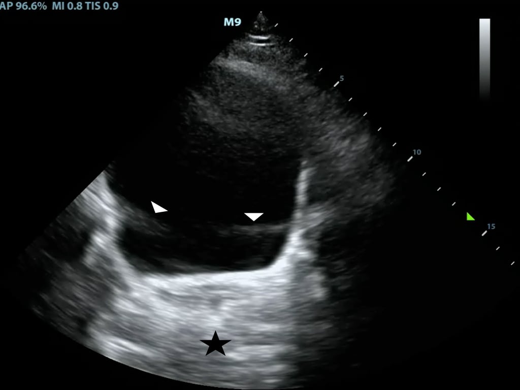 Figure8-Posterior acoustic enhancement deep to the bladder and side lobe artifact.jpeg