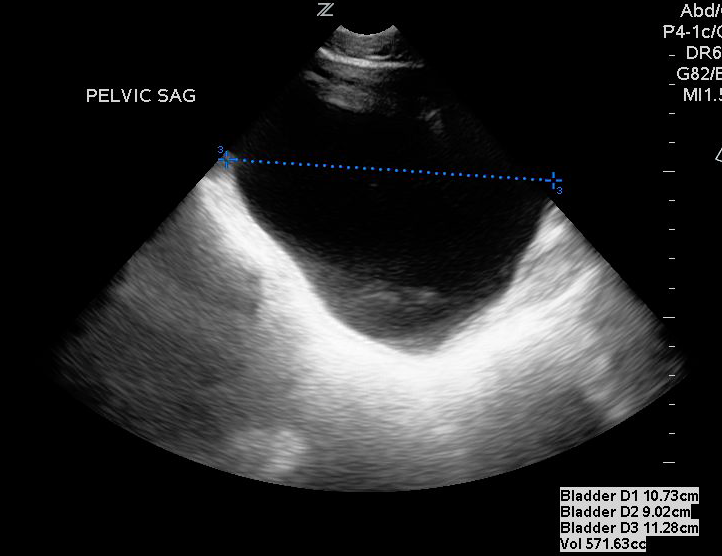 Figure 4- Measurement of bladder in sagittal view.png