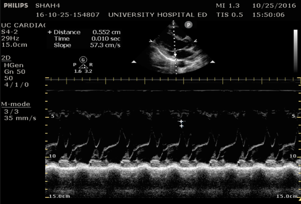 Figure 5 - Image of normal EPSS measurement measured from the tip of the anterior mitral va_BJzf.jpg