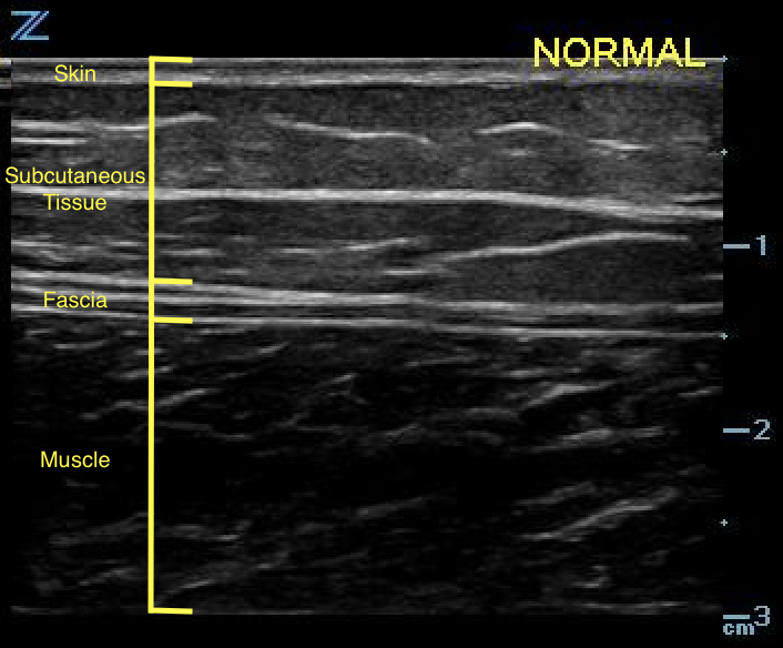 Figure 2. normal skin, subcutaneous tissue, and fascia.png