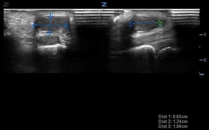 Figure 4. Small ganglion cyst seen transversely (left) and longitudinally (right) above tendon.jpg