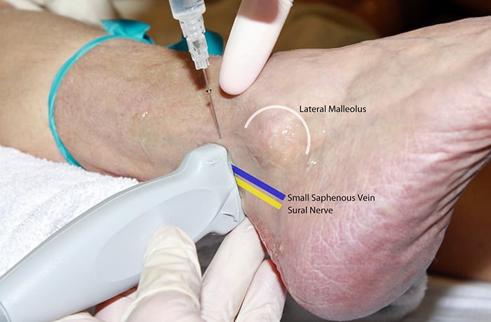 Figure 1. Sural Hands position.jpg