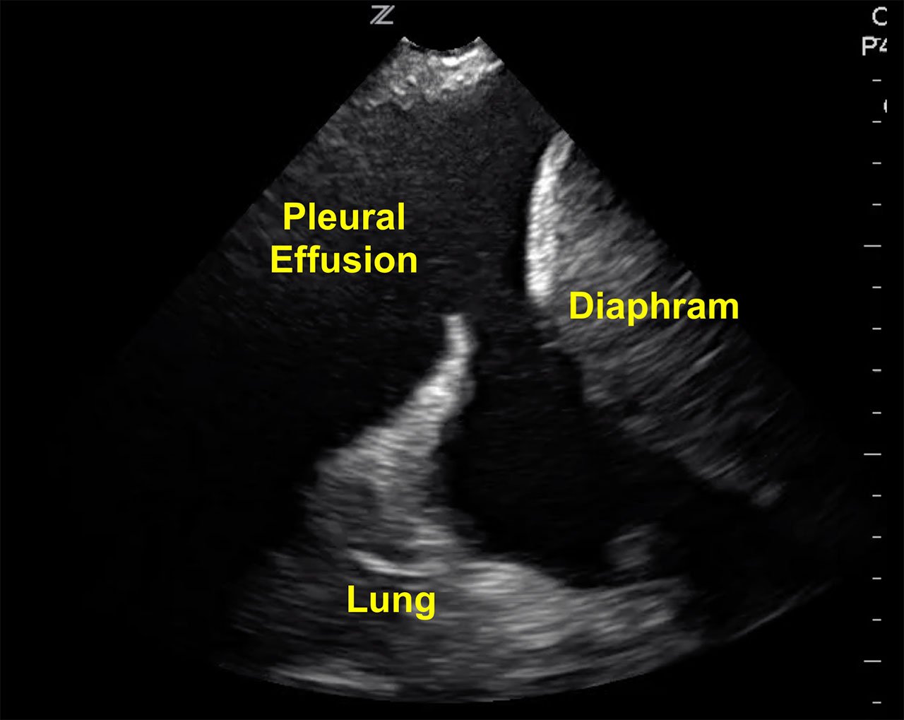 Thoracentesis Figure 1 - Visualizing a large pleural effusion, diaphragm and liver.jpg