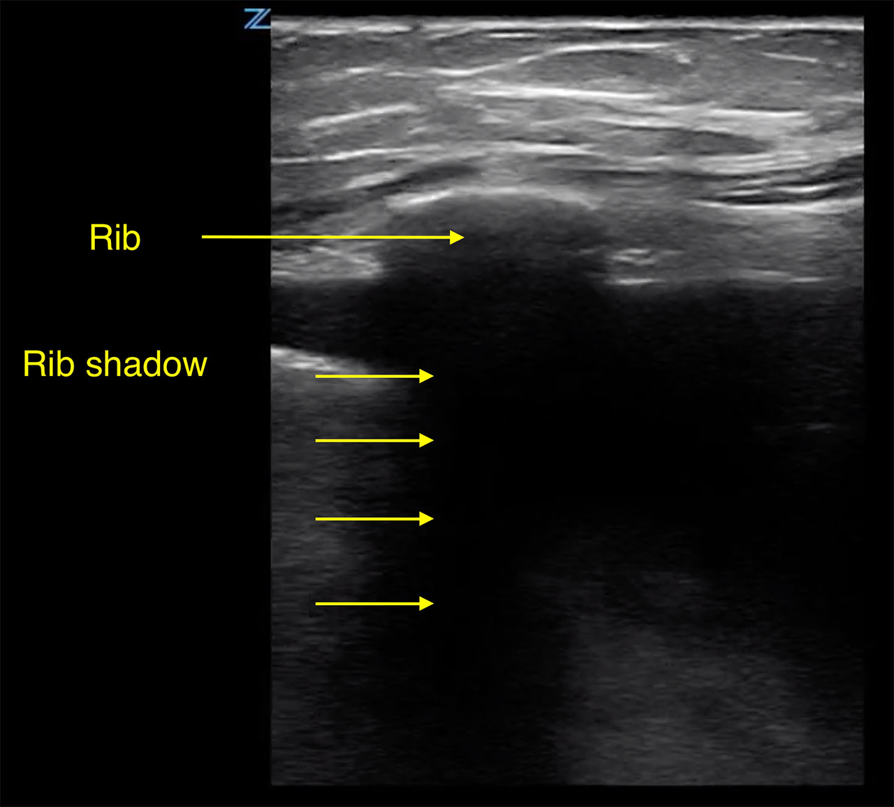 Thoracentesis Figure 4 - Pleural effusion with rib shadow. The transducer is placed perpendicular to the _rZki.jpg