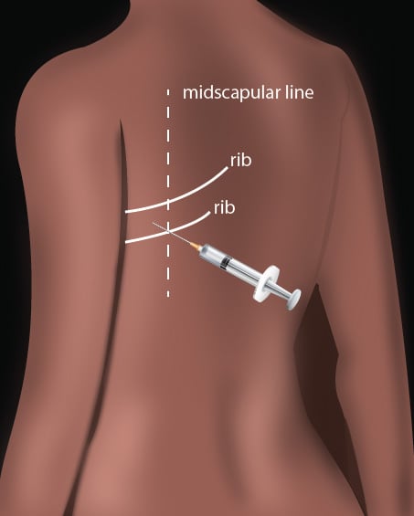 Thoracentesis Ill 1 - Overview of Technique.jpg