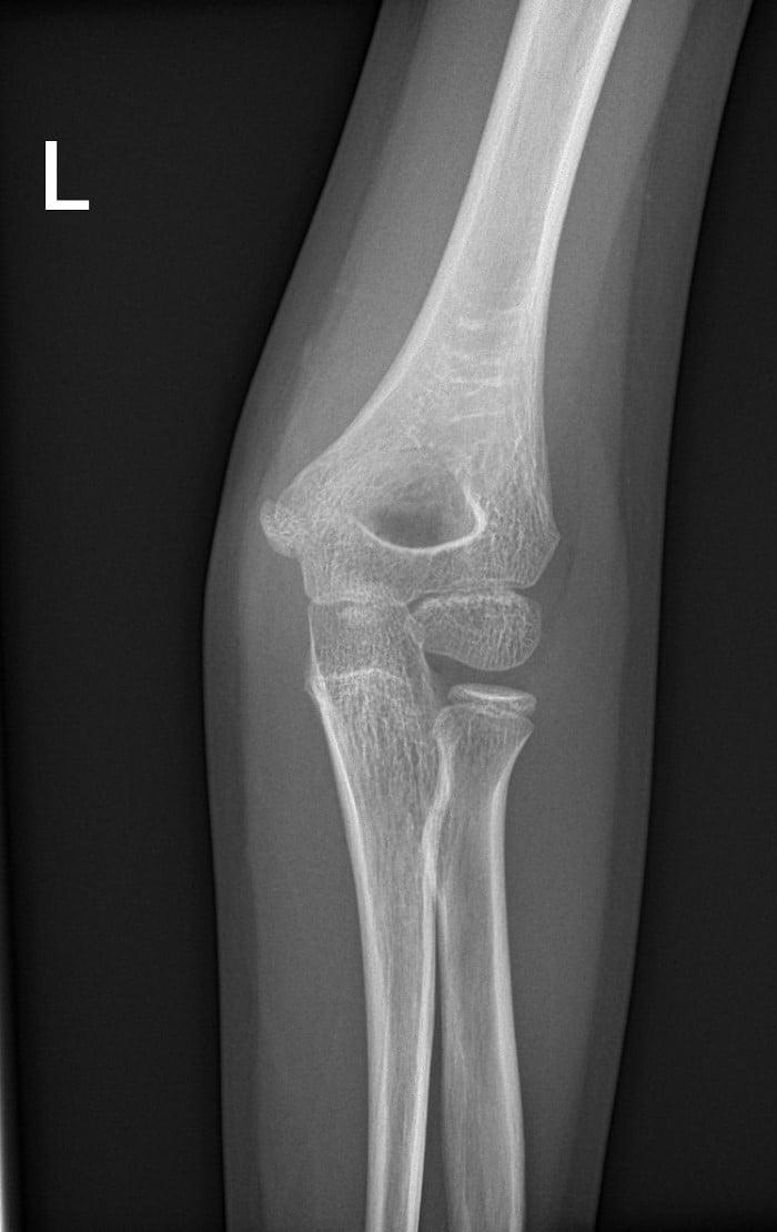 Fig 1.supracondylar-fx-ap.jpg