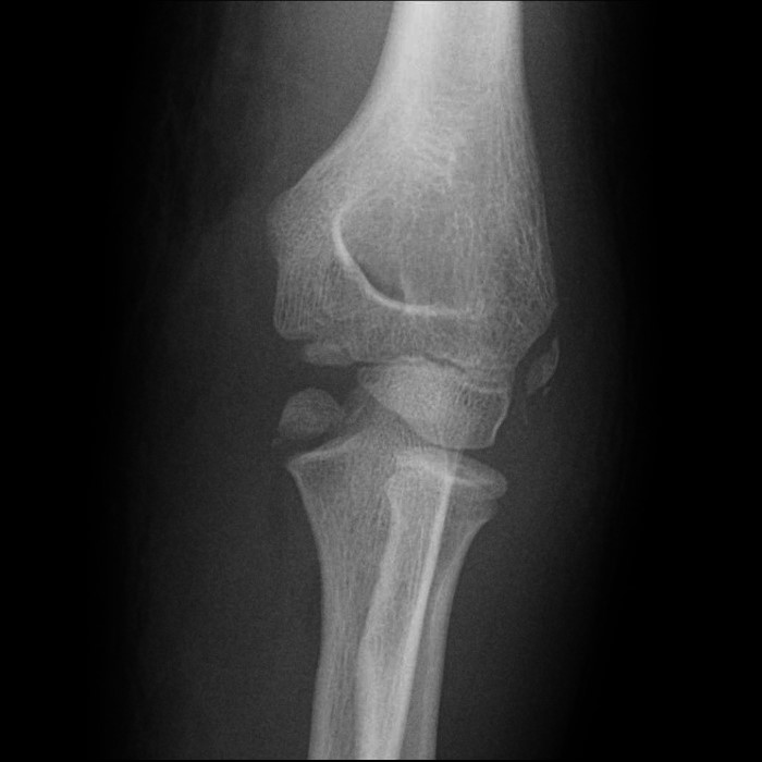 Fig 10.medial-epicondyle-avulsion.jpg