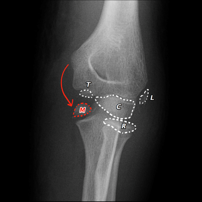 Fig 11.medial-epicondyle-avulsion.png
