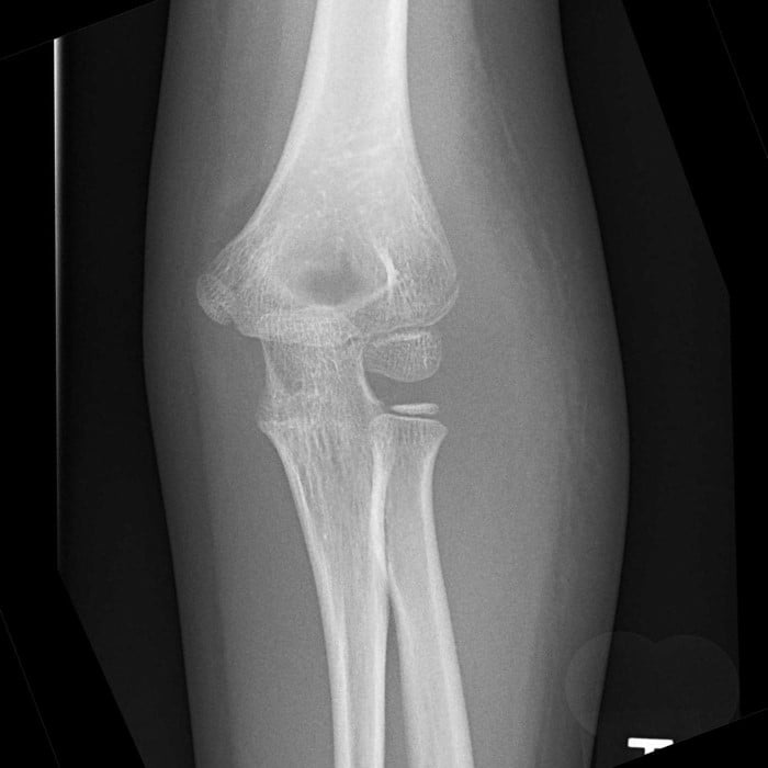 Fig 12.lateral-condyle-fracture-2.jpg