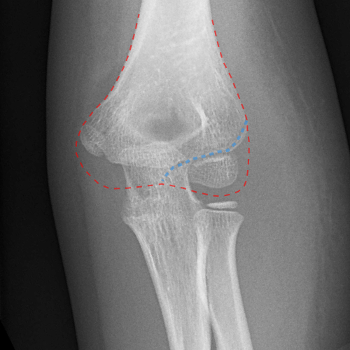 Fig 13.Lateral-condyle-fracture-2-2.jpg