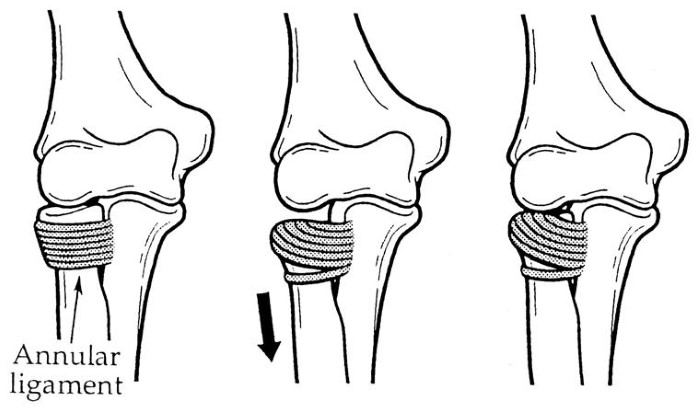 Fig 14..nursemaid elbow.jpg