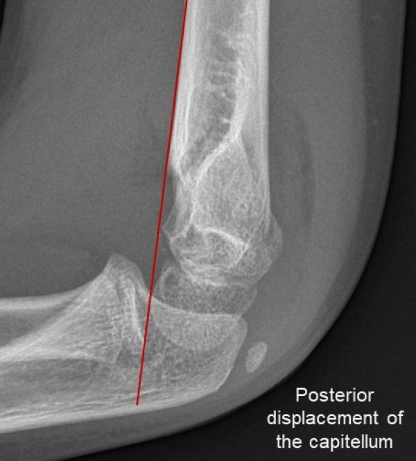 Fig 18.supracondylar-fx-AHL.jpg