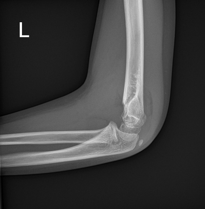 Fig 2.supracondylar-fx-lat.jpg
