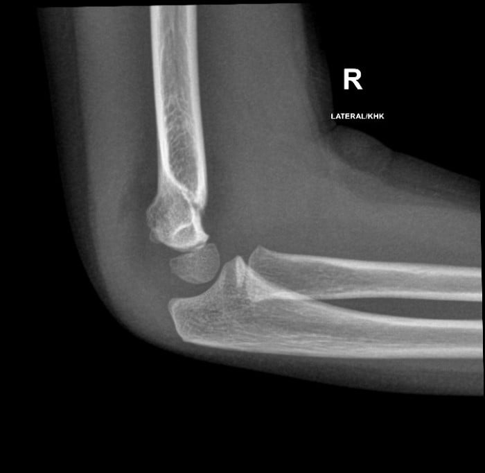 Fig 3.supracondylar-fracture-with-posterior-fat-pad-and-sail-signs.jpeg